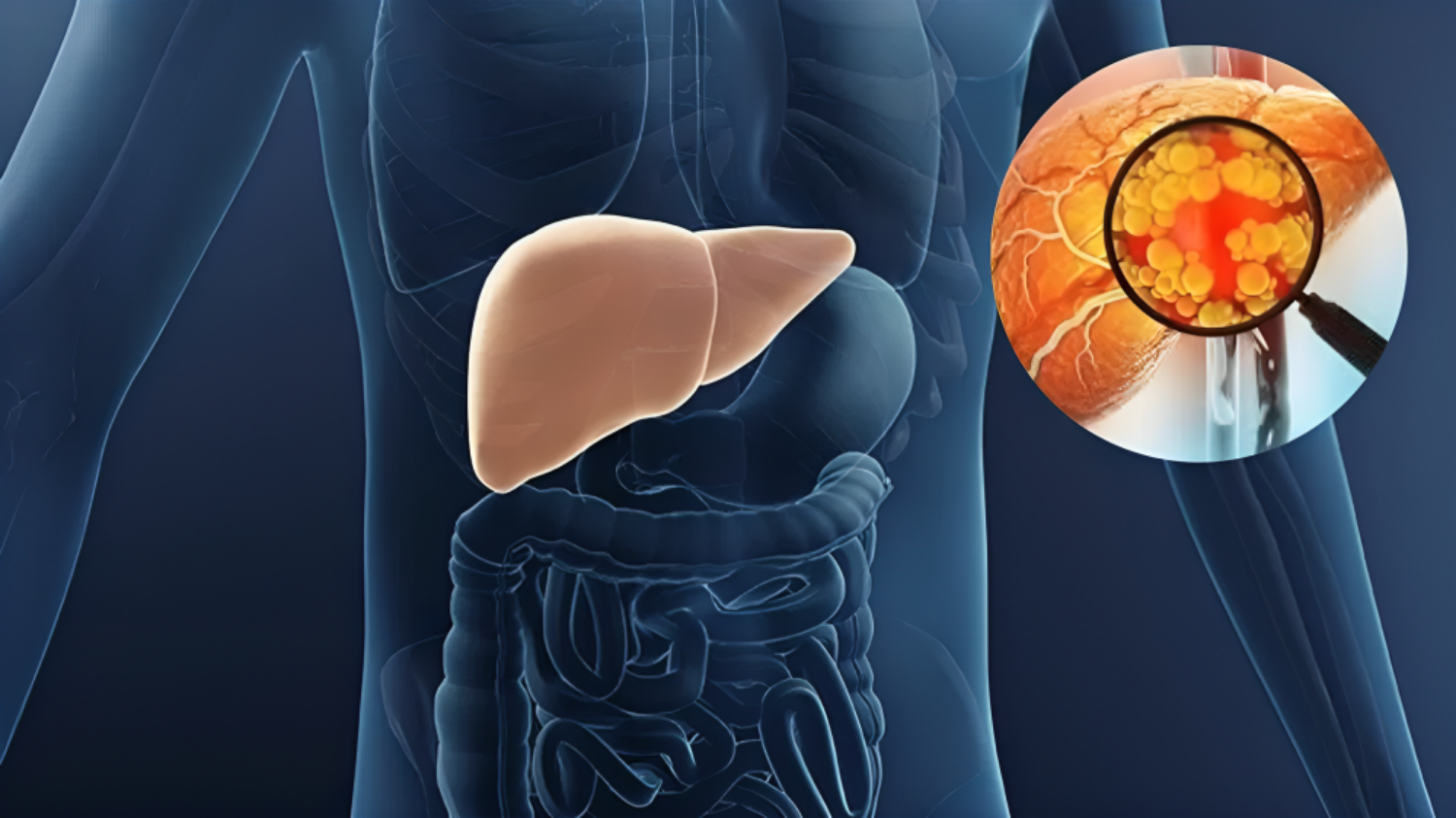 Picture of Fatty Liver: Try These 4 Ayurvedic Remedies To Avoid Fatty Liver, Immediate Relief