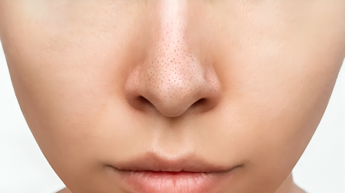 Picture of Are you bothered by stubborn blackheads? So adopt this home remedy to remove it