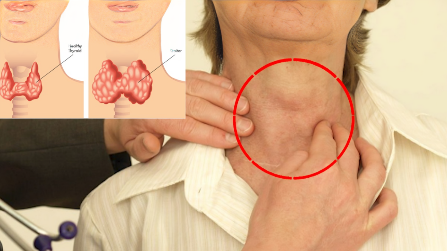 Picture of Signs of hypothyroidism that helps in early detection