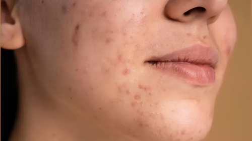 Picture of Know these 4 foods that make your face full of acne
